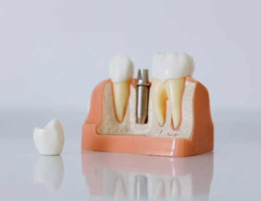 Model of a Dental Implant