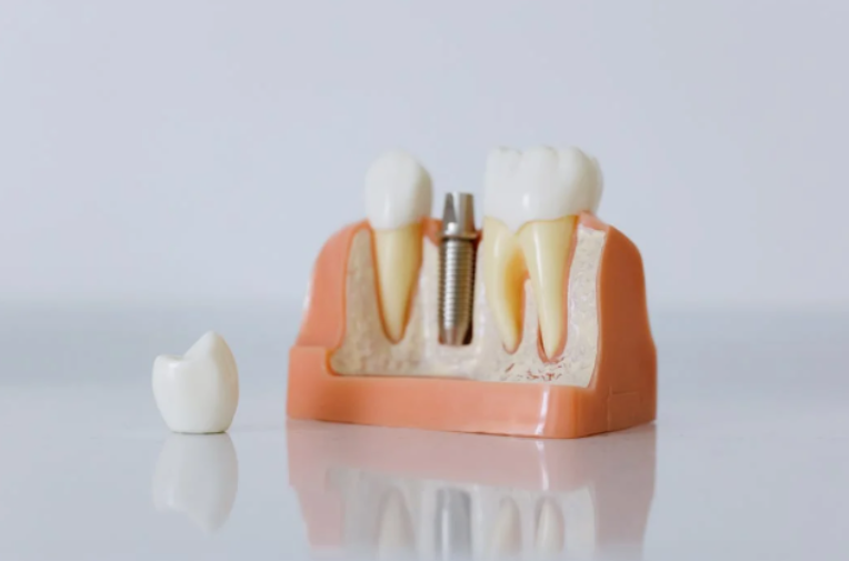 Model of a Dental Implant